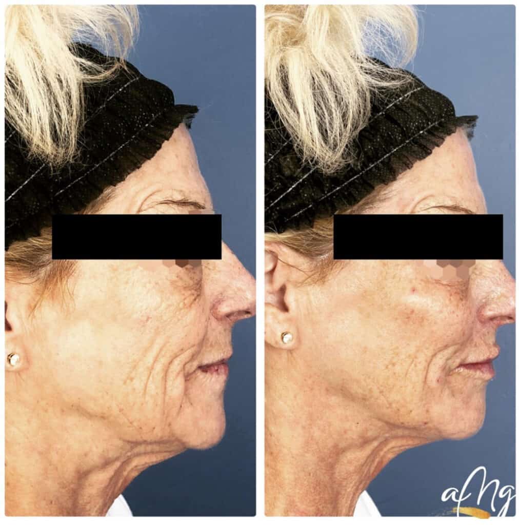 Before and After