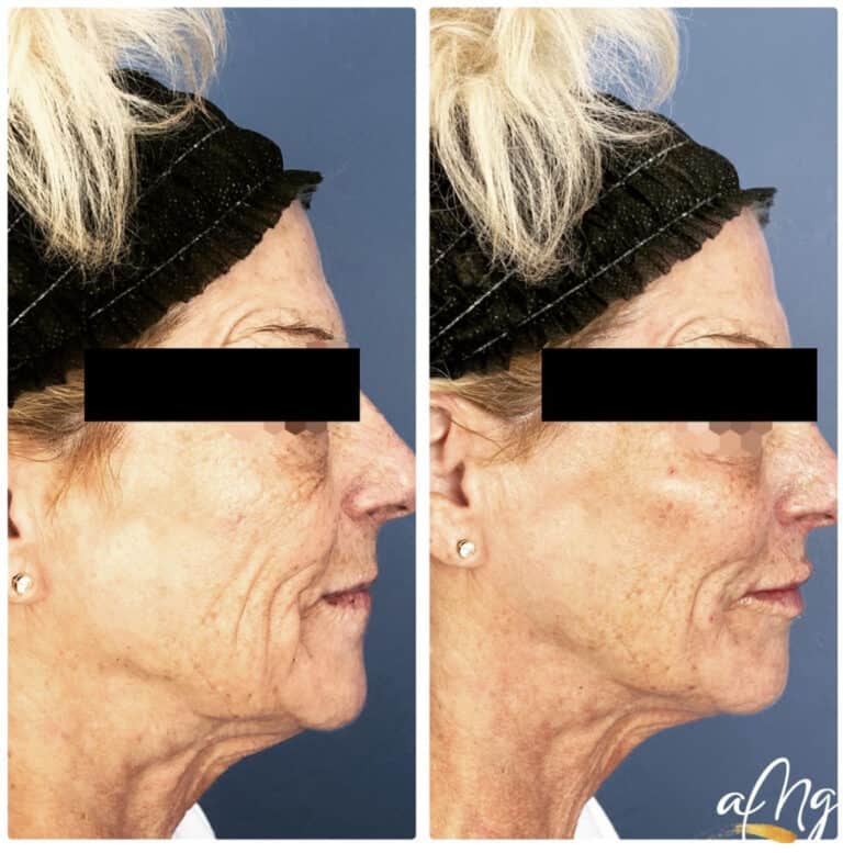 Before and After