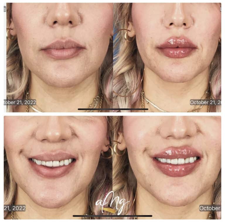 Before and After