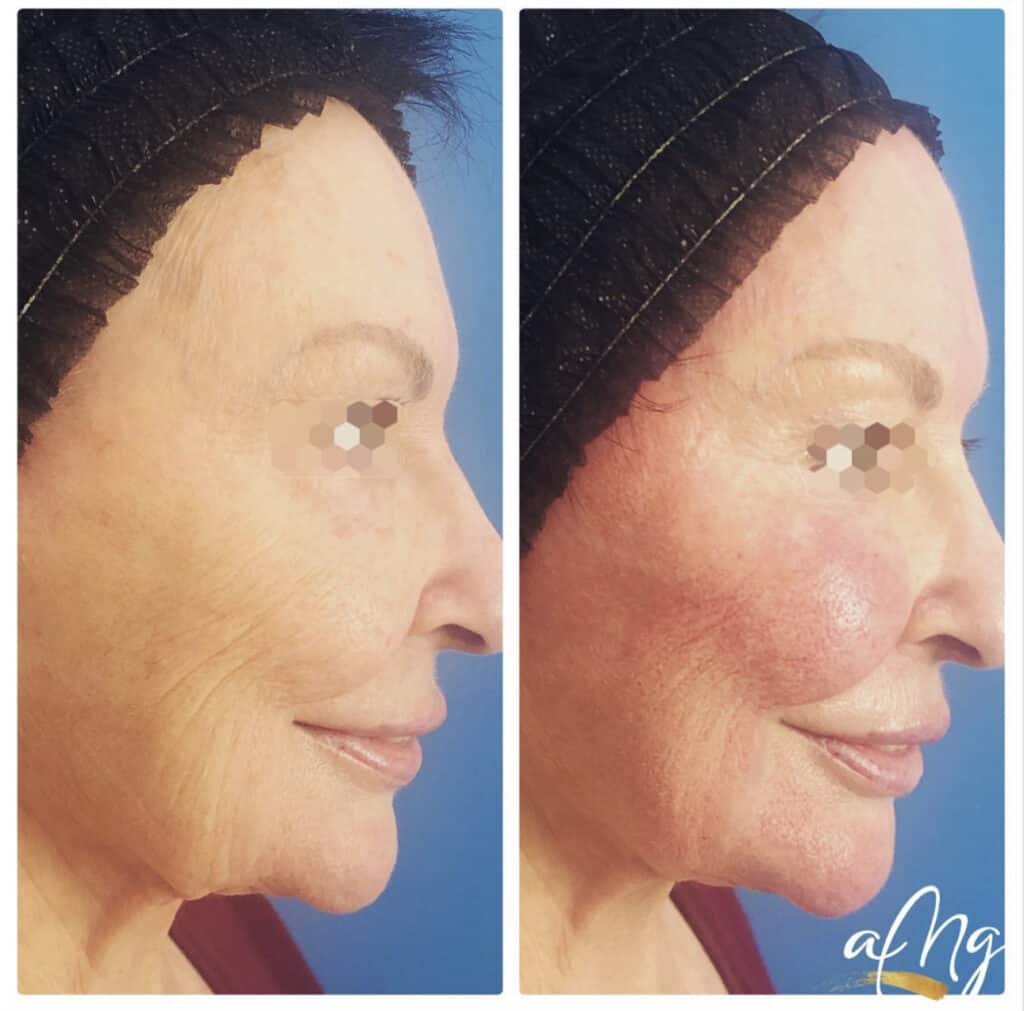Before and After