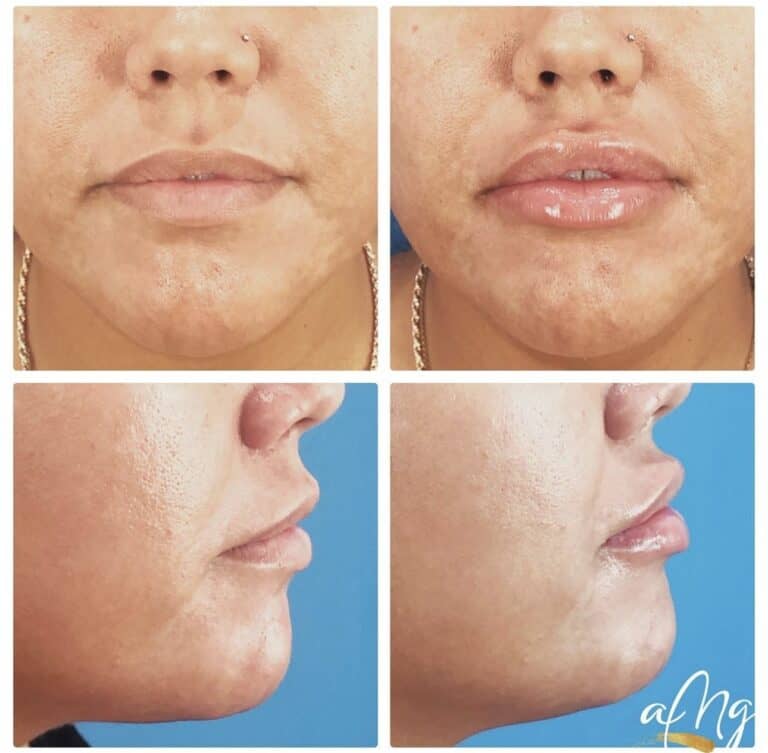 Before and After