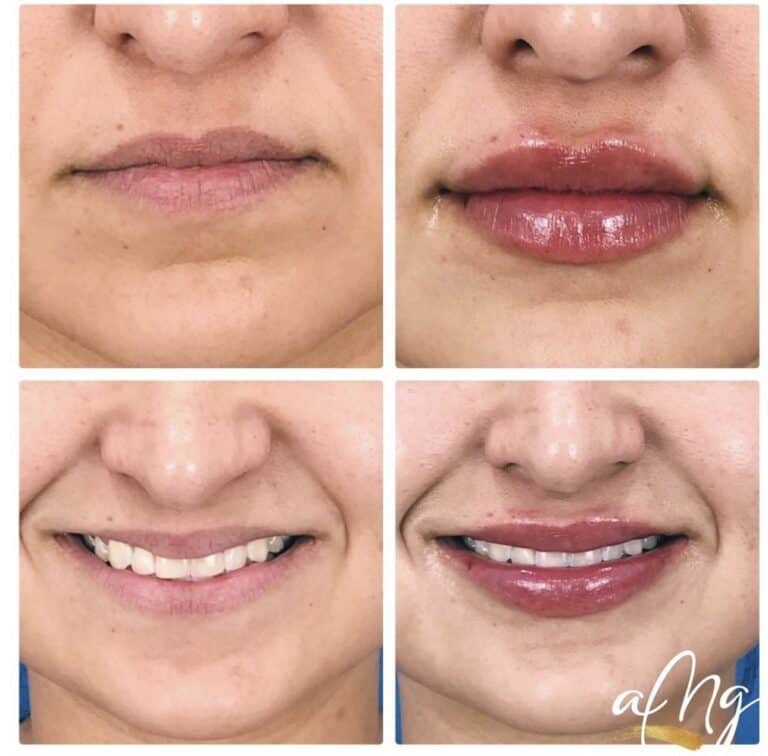 Before and After