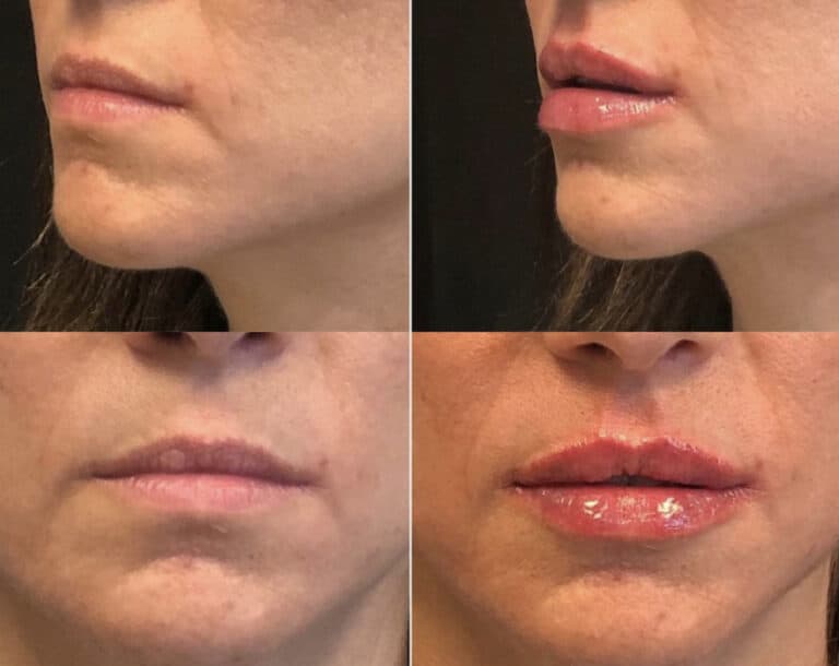 Before and After