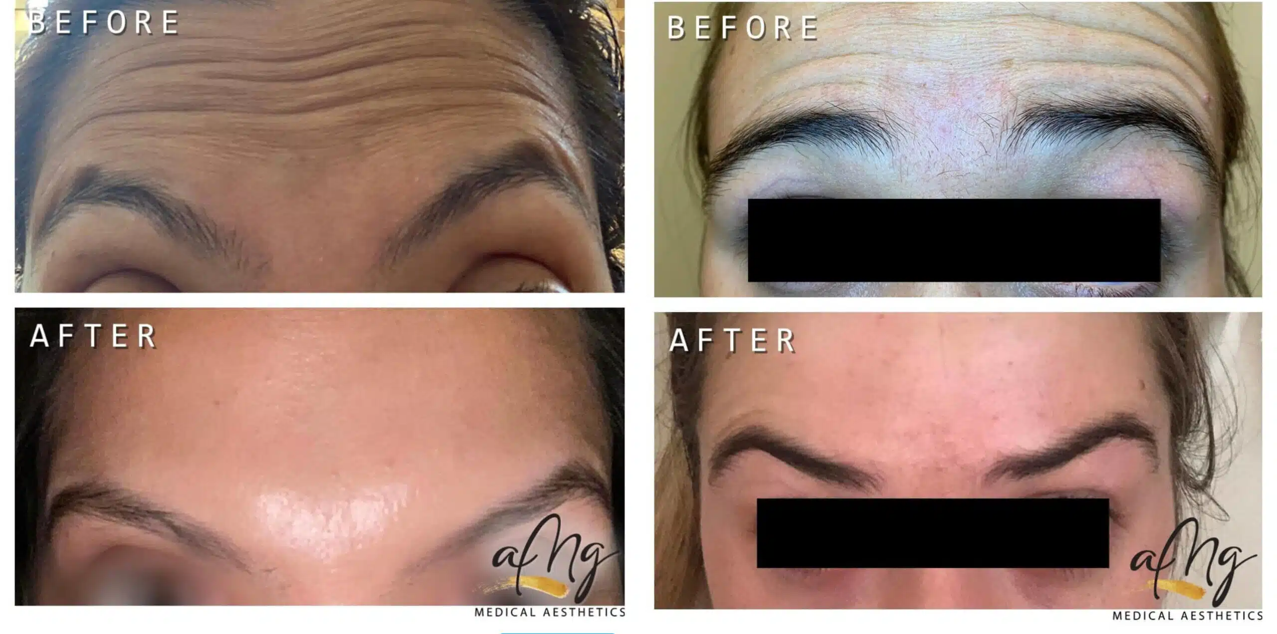Xeomin Before and After