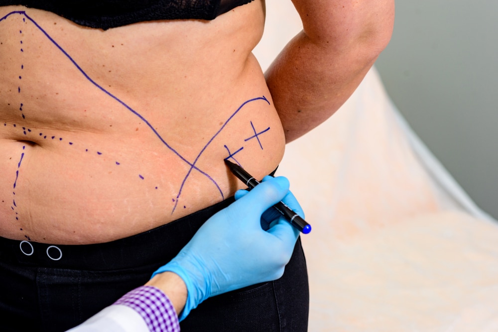 Body Contouring | AMG Aesthetics